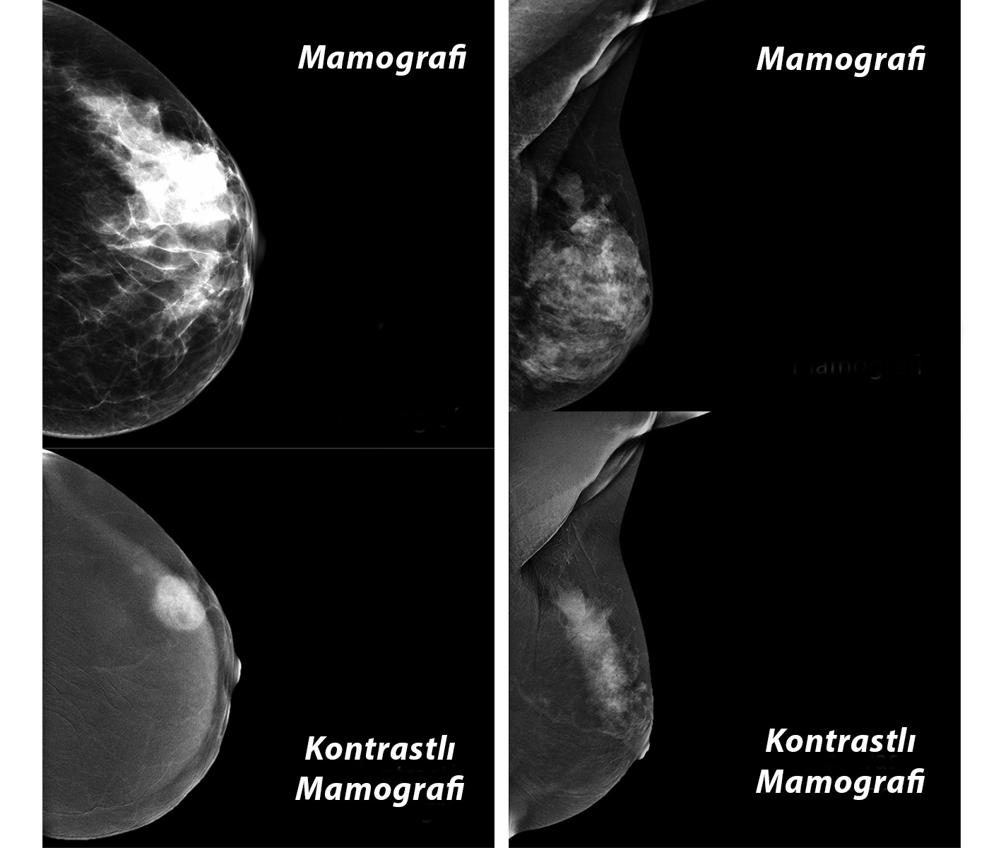 kontrastli_mamografi.jpg